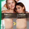 Sivilce Önleyici ve Karşıtı Akne, Siyah Nokta, Leke Giderici Yüz Kremi 100 ml